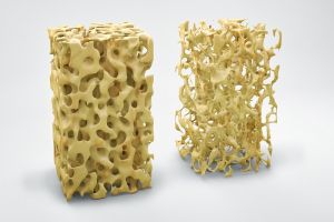 Osteoporose – Belastung fürs Gesundheitssystem