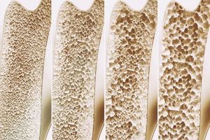 Ernährung und Bewegung bei Osteoporose machen Knochen stark